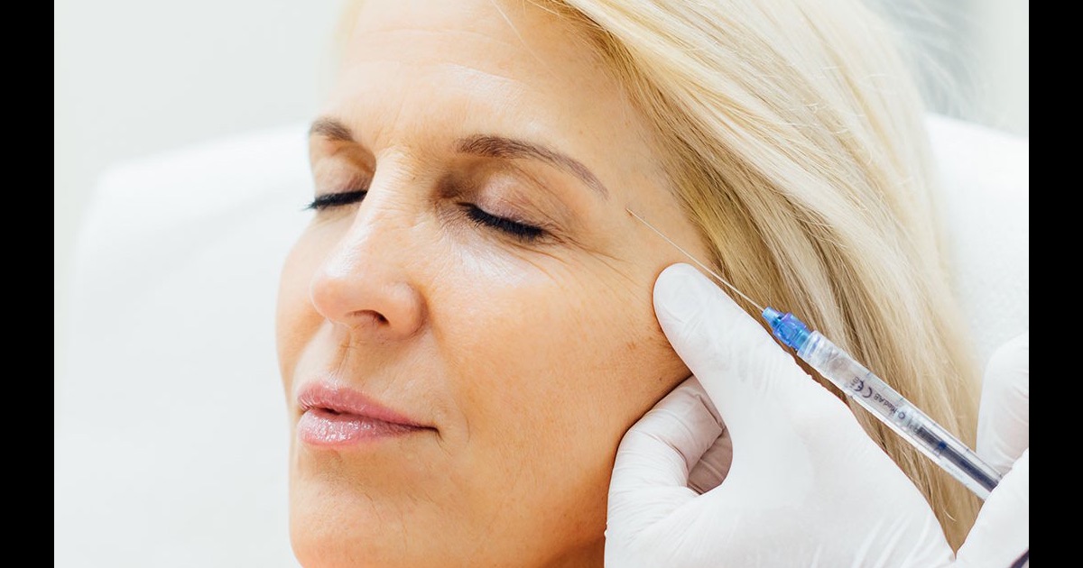 Warum kann ein Lippenlifting (Bullhorn Lift) das Ergebnis eines Facelifts perfektionieren?