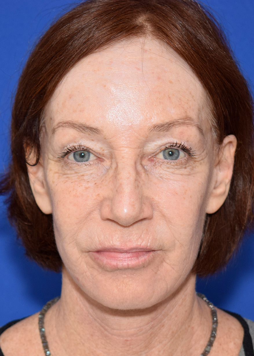 Deep Plane Facelifting Nachher