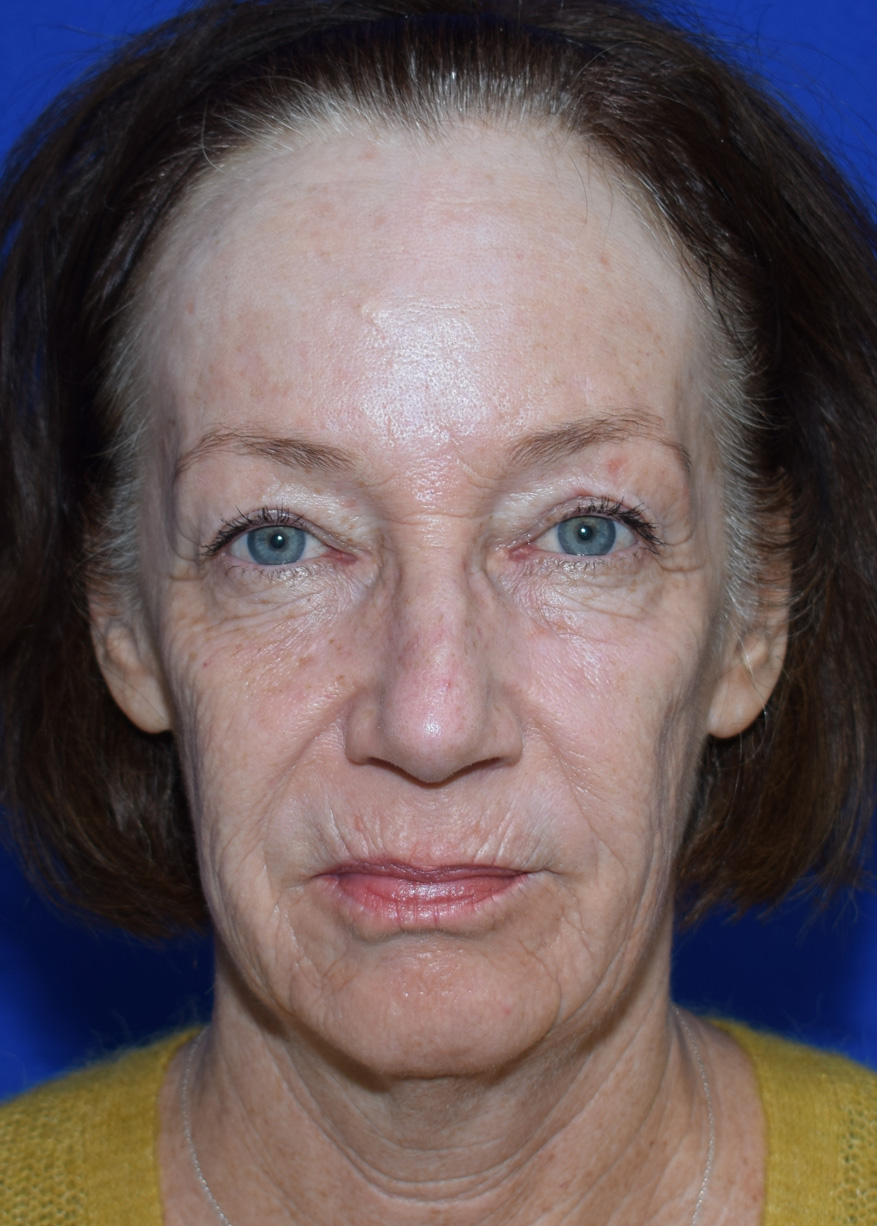 Deep Plane Facelifting Vorher