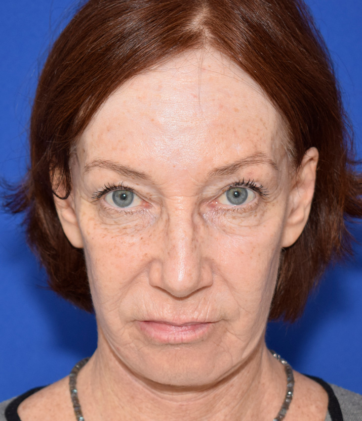 Deep Plane Facelifting Nachher (2)