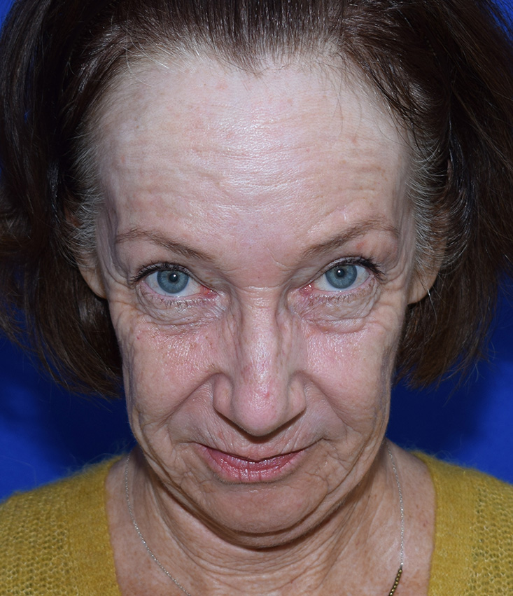 Deep Plane Facelifting Vorher (2)