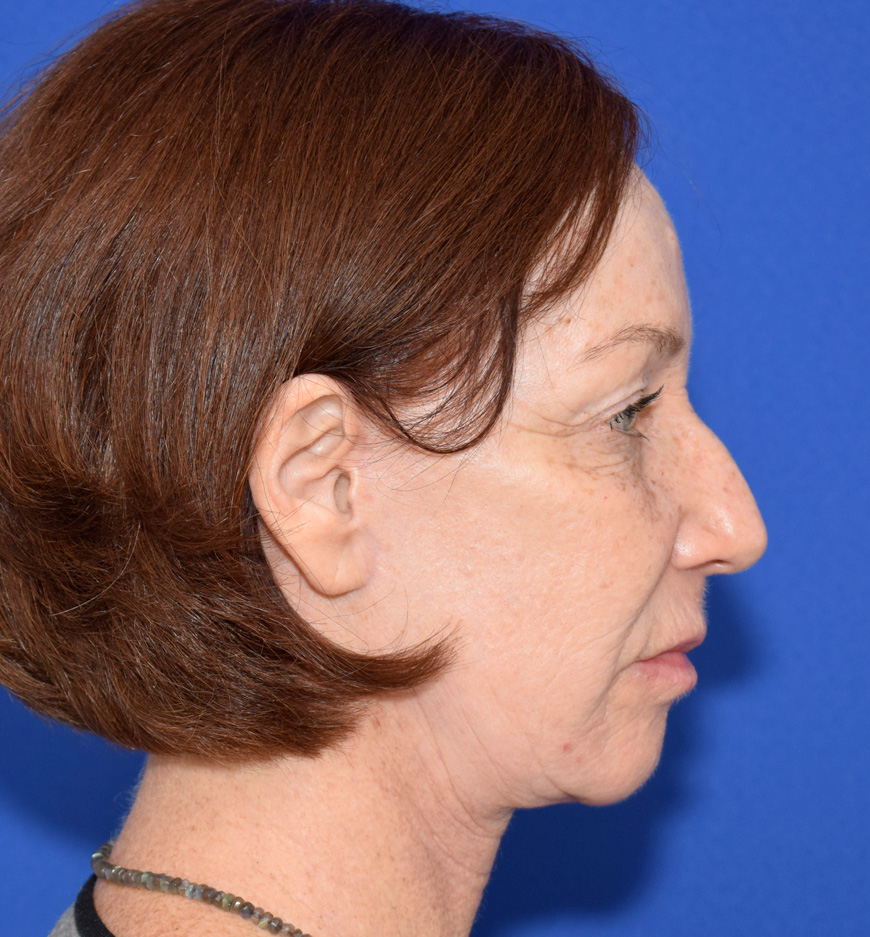 Deep Plane Facelifting Nachher (3)