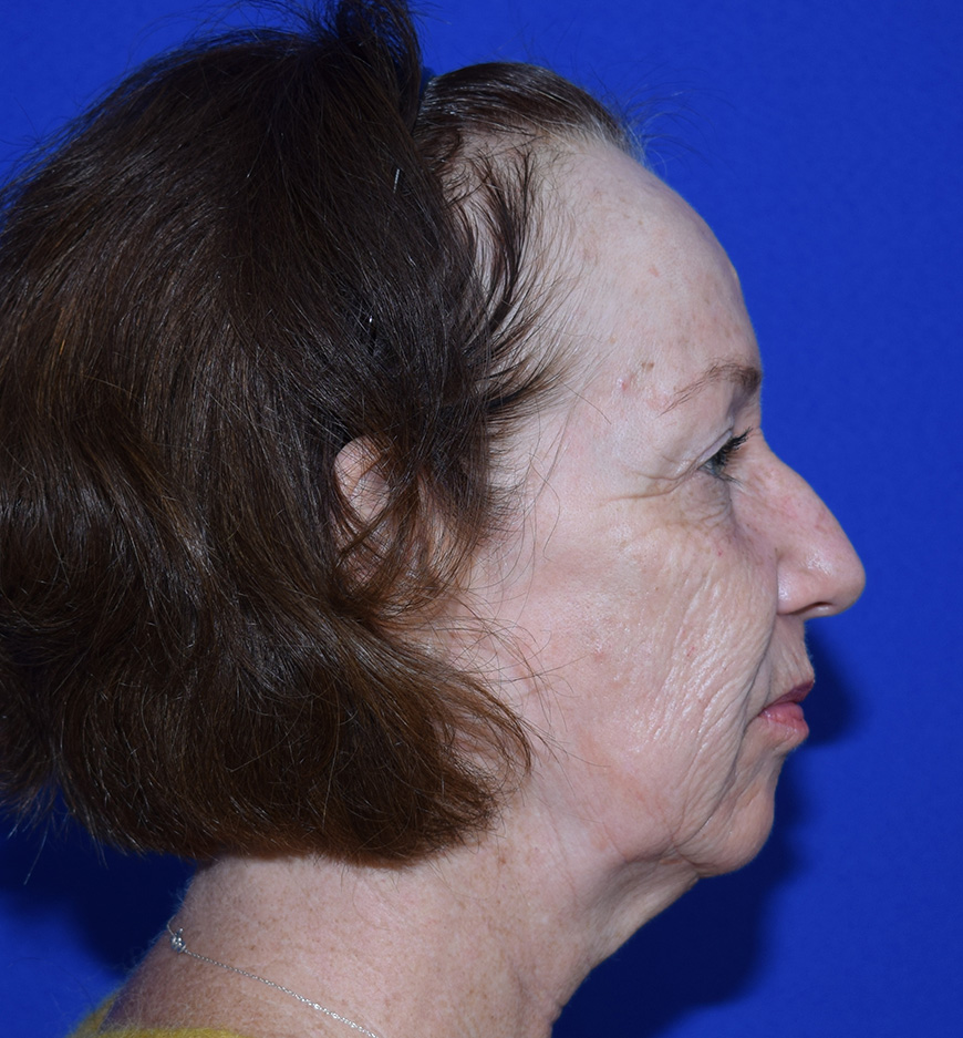 Deep Plane Facelifting Vorher (3)