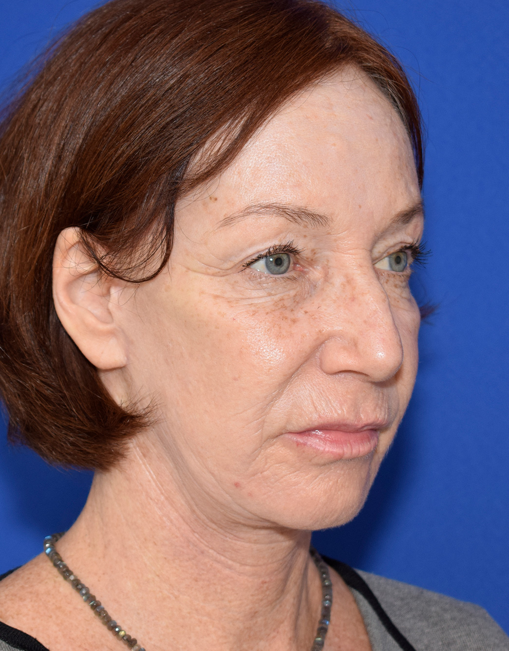 Deep Plane Facelifting Nachher (4)