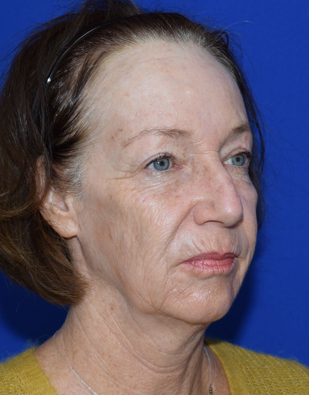 Deep Plane Facelifting Vorher (4)