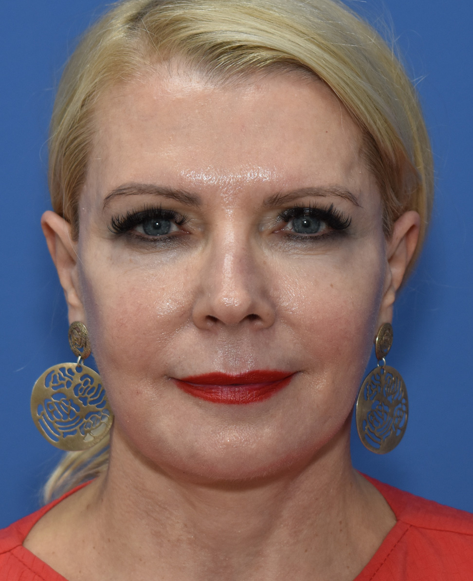 Deep Plane Facelifting Nachher