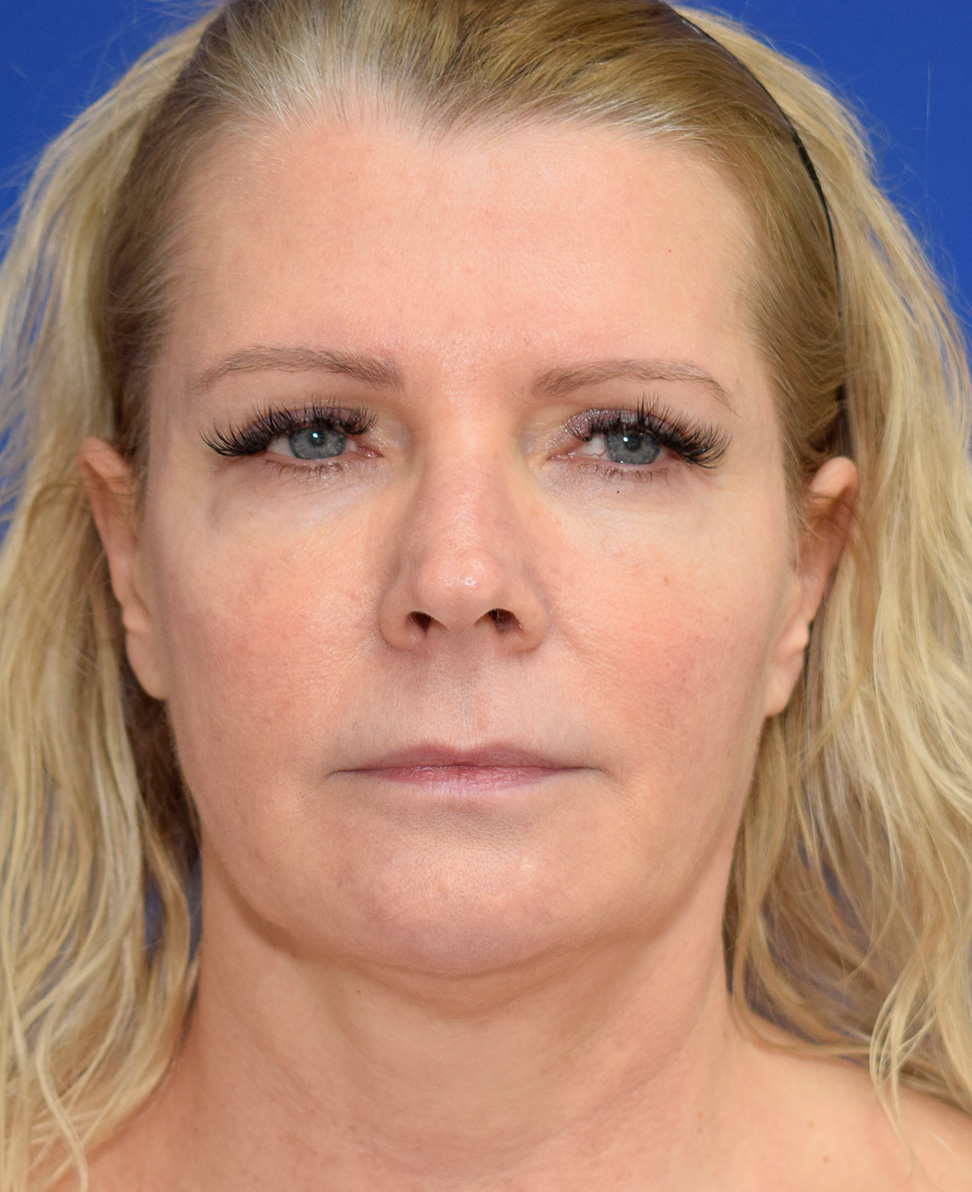 Deep Plane Facelifting Vorher