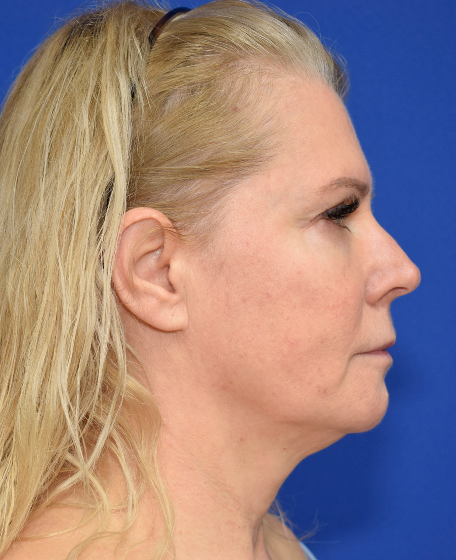 Deep Plane Facelifting Vorher (2)