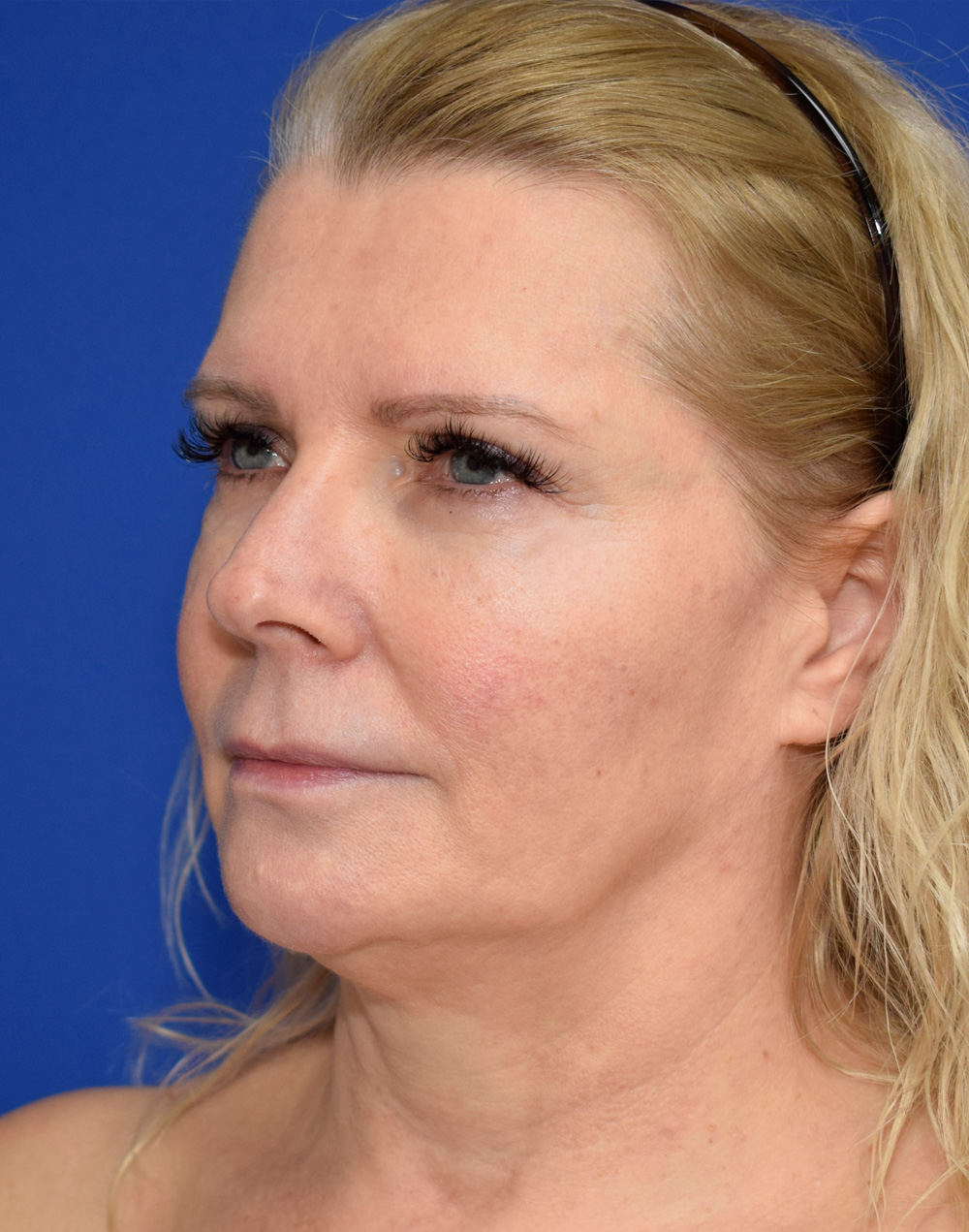 Deep Plane Facelifting Vorher (3)