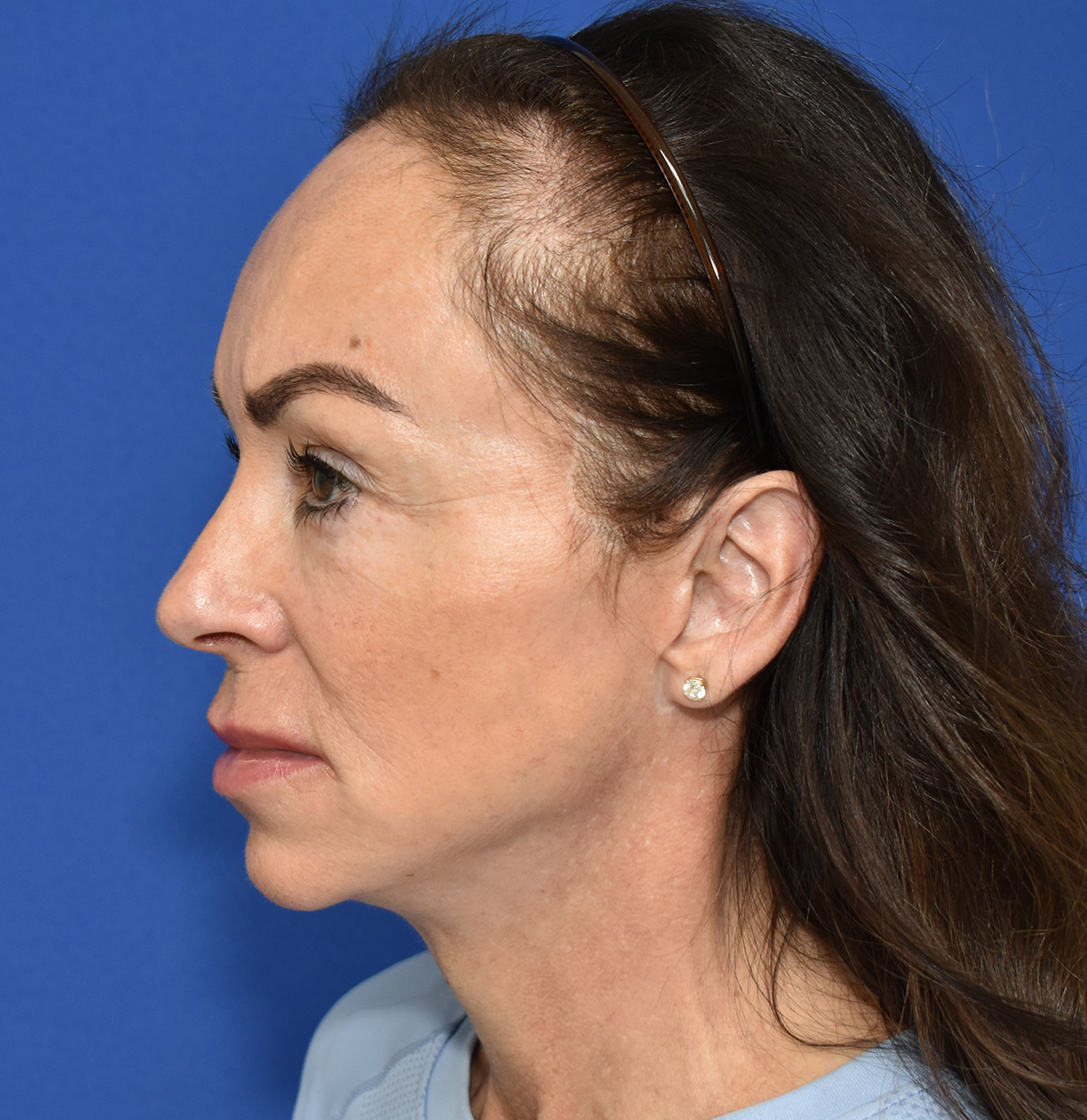 Deep Plane Facelifting Nachher (2)