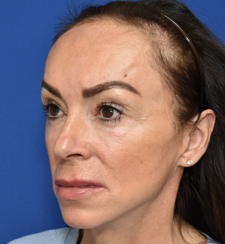 Deep Plane Facelifting Nachher (3)