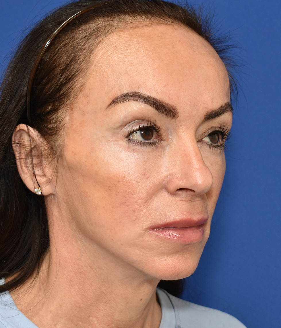 Deep Plane Facelifting Nachher (4)
