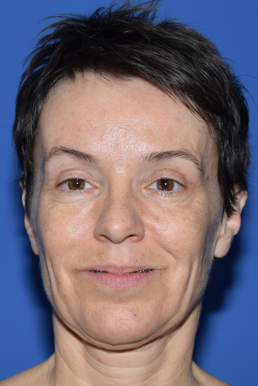 SMAS Facelifting Vorher