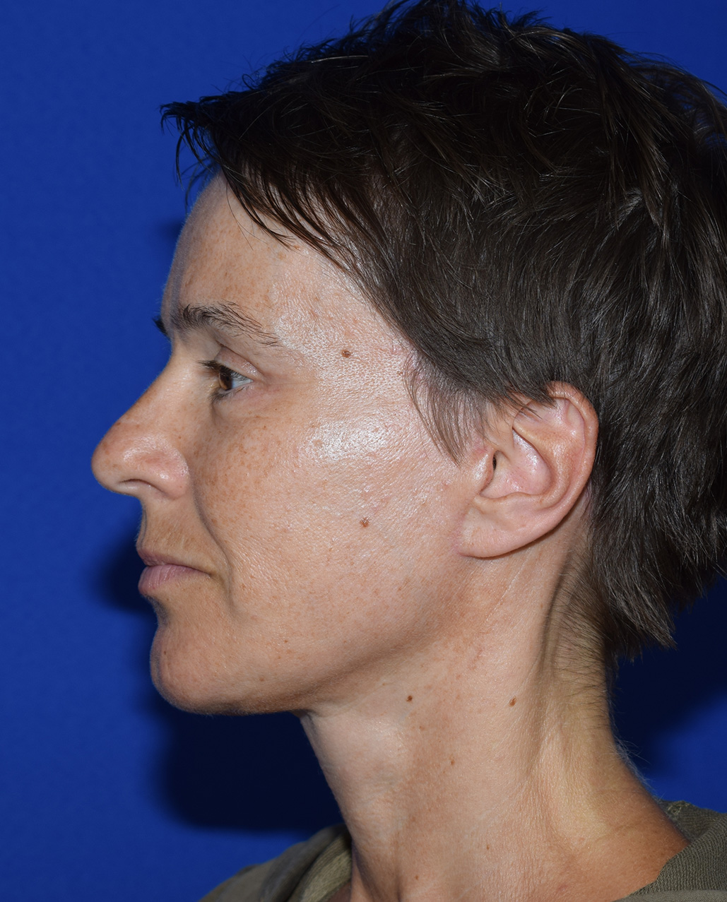 SMAS Facelifting Nachher (2)