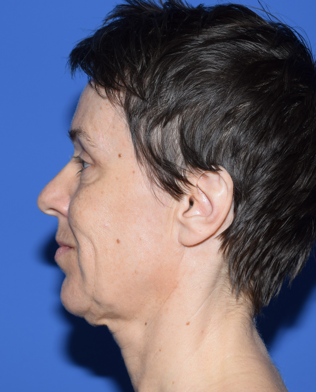 SMAS Facelifting Vorher (2)