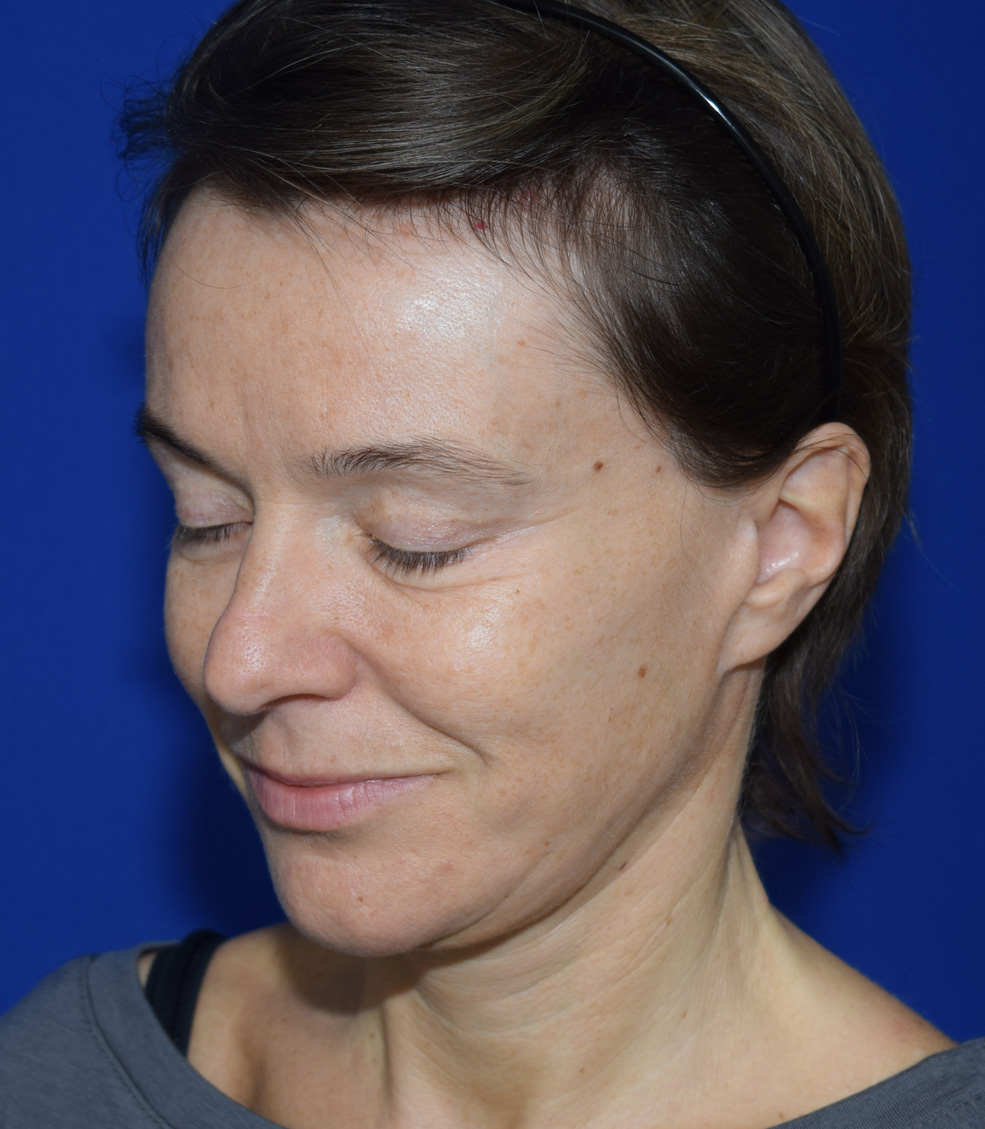 SMAS Facelifting Nachher (3)