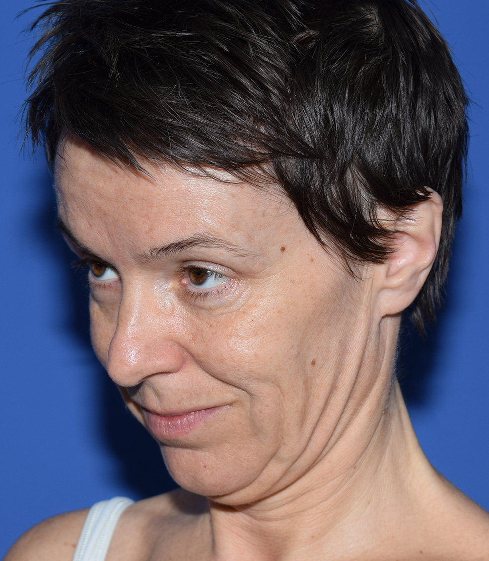 SMAS Facelifting Vorher (3)