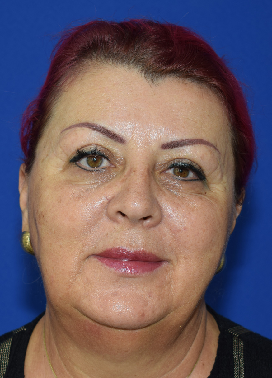 SMAS Facelifting Vorher