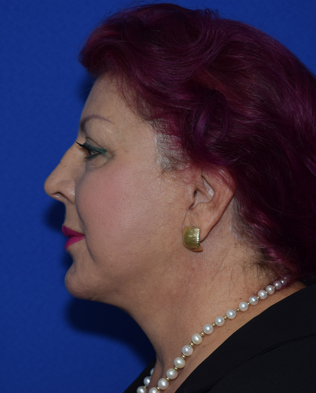 SMAS Facelifting Nachher (3)