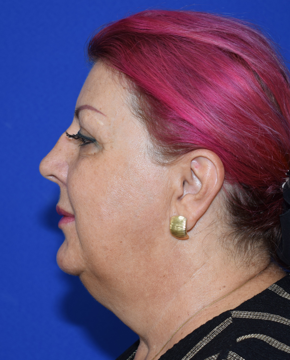 SMAS Facelifting Vorher (3)
