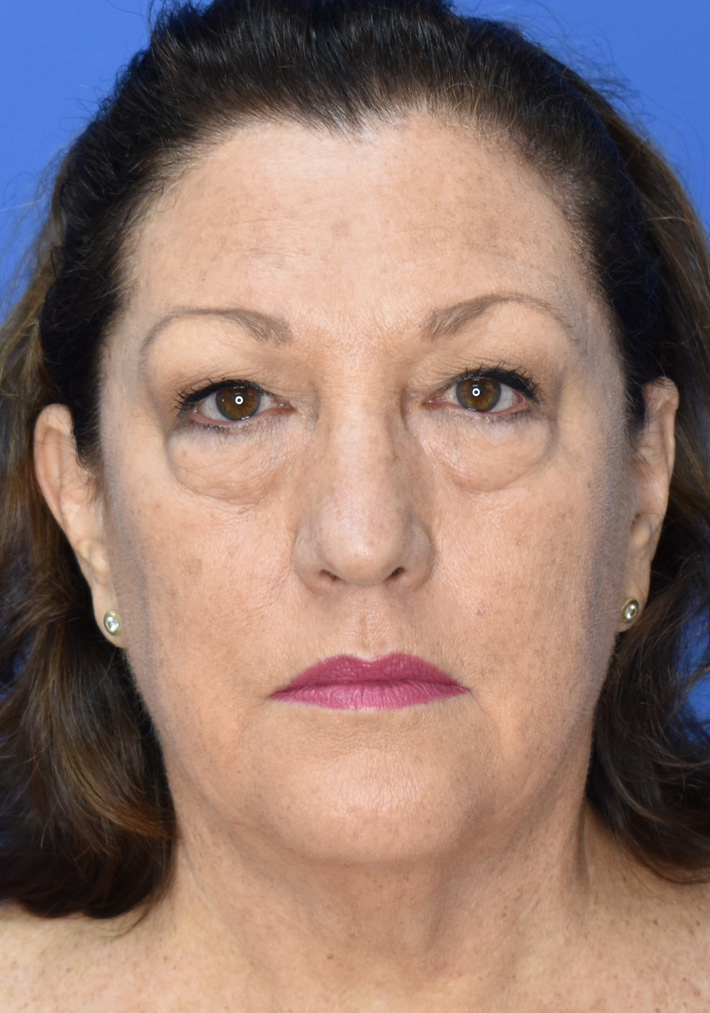 Deep Plane Facelifting Vorher