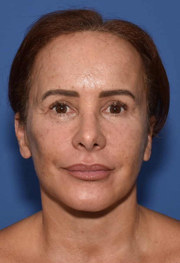 Deep Plane Facelifting Nachher