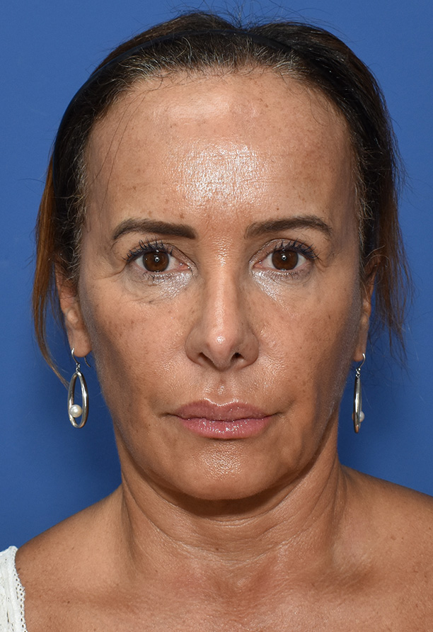 Deep Plane Facelifting Vorher