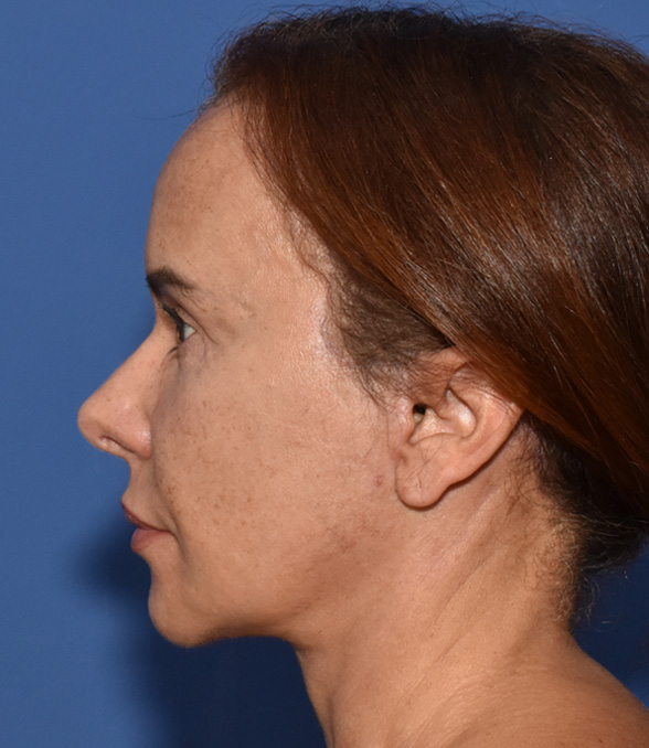Deep Plane Facelifting Nachher (2)