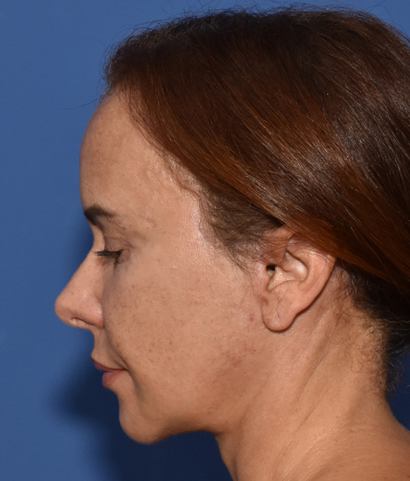 Deep Plane Facelifting Nachher (3)