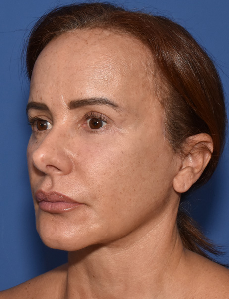 Deep Plane Facelifting Nachher (4)