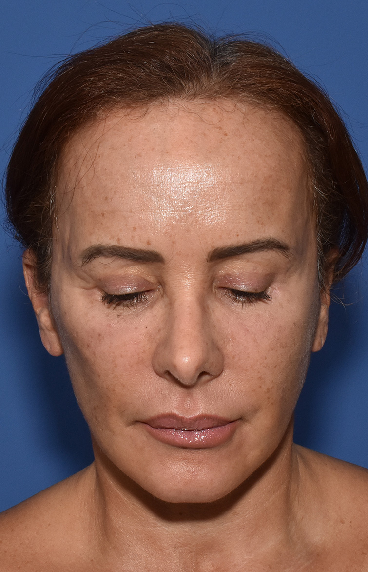 Deep Plane Facelifting Nachher (5)