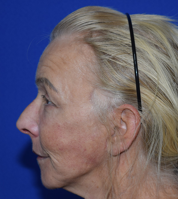 SMAS Facelifting Nachher (2)