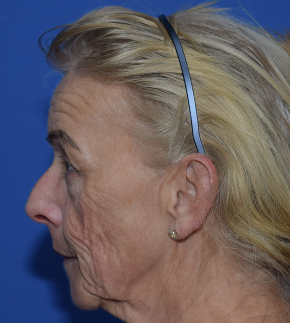 SMAS Facelifting Vorher (2)
