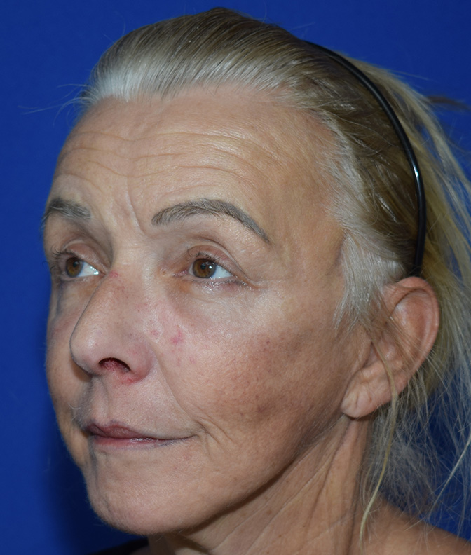 SMAS Facelifting Nachher (3)