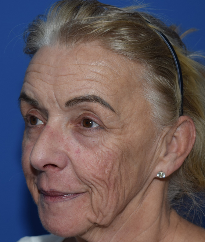 SMAS Facelifting Vorher (3)